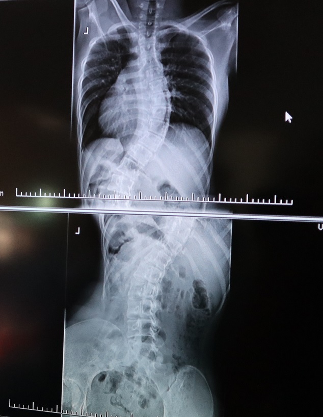 FNsP ZA Idiopatická skolióza 16 ročnej pacientky pred operáciou