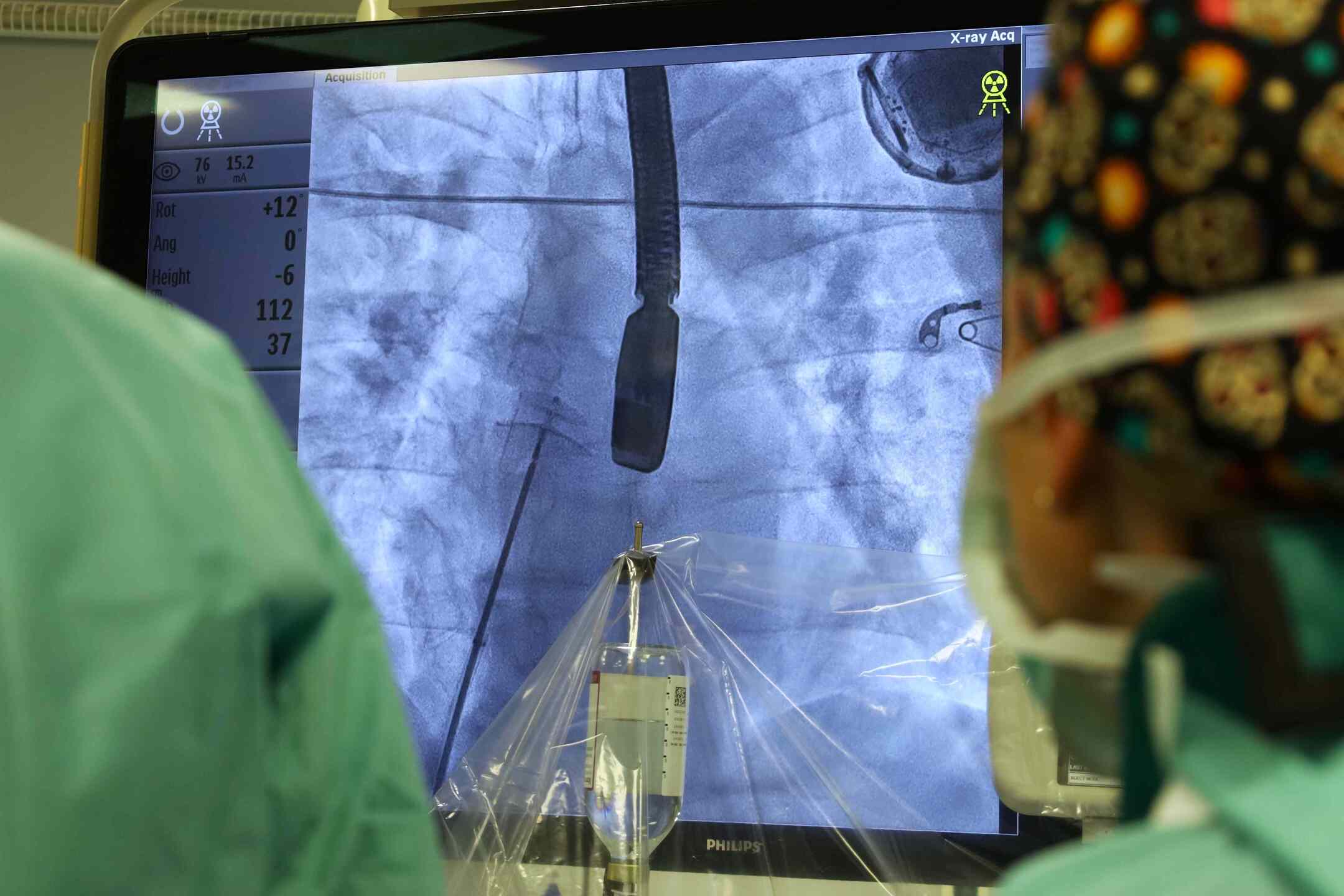 FNsP ZA Štrukturálne intervenčné výkony umožňujú priamo riešiť anatomické odchýlky v srdci pacientov